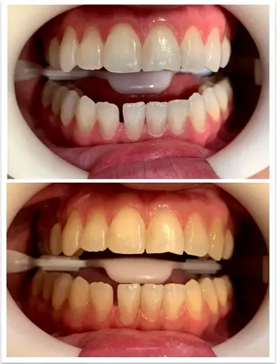 Clareamento Dental — antes e depois