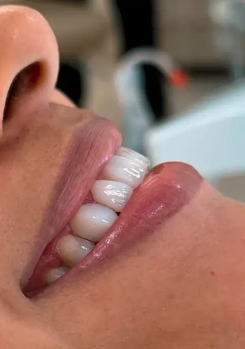 Restauração Dental